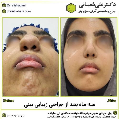 جراحی-بینی-در-بابل252