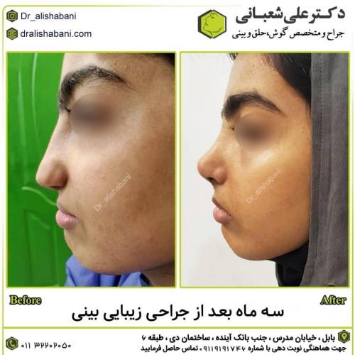 جراحی-بینی-در-بابل253