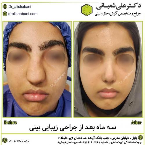 جراحی-بینی-در-بابل254