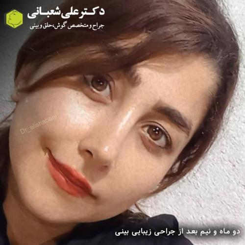 جراحی-بینی-در-بابل255