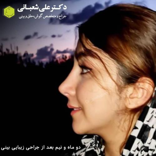 جراحی-بینی-در-بابل256
