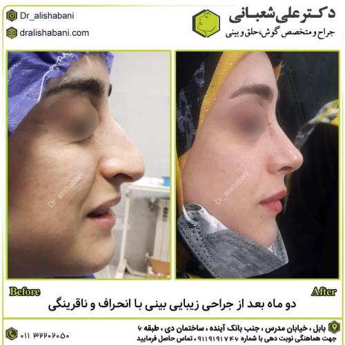 جراحی-بینی-در-بابل257 (1)