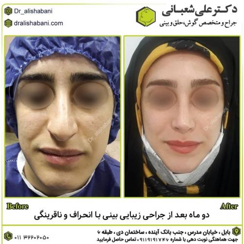 جراحی-بینی-در-بابل258 (1)