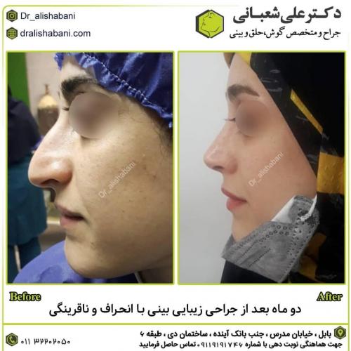 جراحی-بینی-در-بابل259 (1)