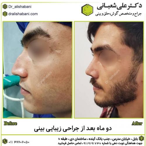 جراحی-بینی-در-بابل260 (1)