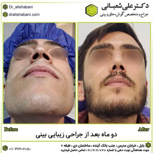 جراحی-بینی-در-بابل261 (1)