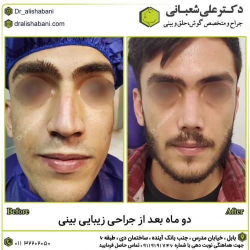 جراحی-بینی-در-بابل262 (1) (1)