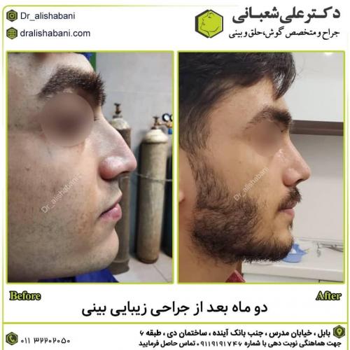 جراحی-بینی-در-بابل263 (1) (1)