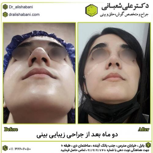 جراحی-بینی-در-بابل264 (1) (1)