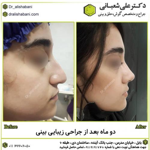 جراحی-بینی-در-بابل265 (1) (1)