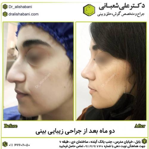 جراحی-بینی-در-بابل266 (1) (1)