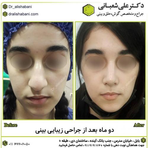 جراحی-بینی-در-بابل267 (1) (1)