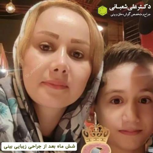 جراحی-بینی-در-بابل269 (1) (1)