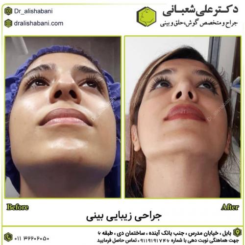 جراحی-بینی-در-بابل273 (1) (1)
