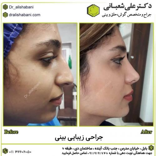جراحی-بینی-در-بابل274 (1)