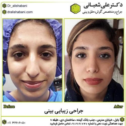جراحی-بینی-در-بابل275