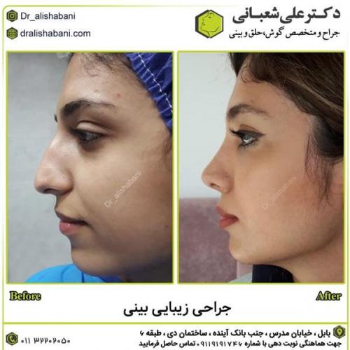 جراحی-بینی-در-بابل276