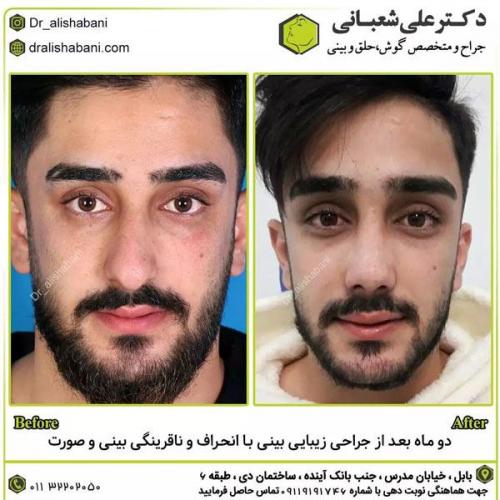 جراحی-بینی-در-بابل277