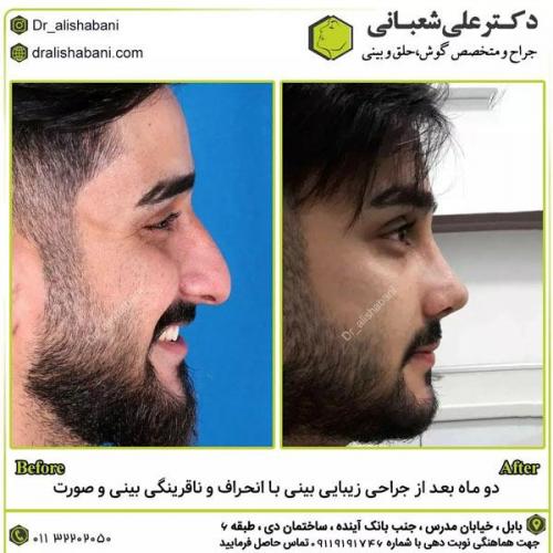 جراحی-بینی-در-بابل278