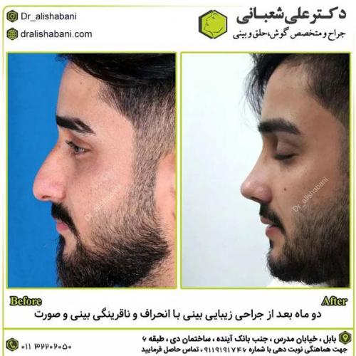 جراحی-بینی-در-بابل279