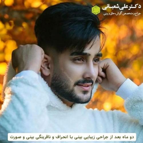 جراحی-بینی-در-بابل280