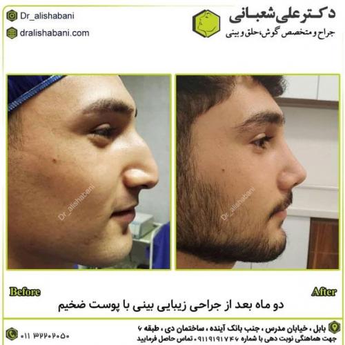 جراحی-بینی-در-بابل281