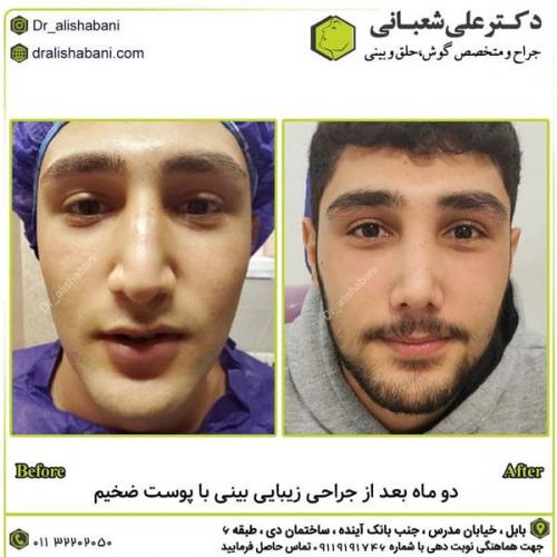 جراحی-بینی-در-بابل282