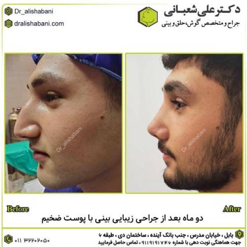جراحی-بینی-در-بابل283
