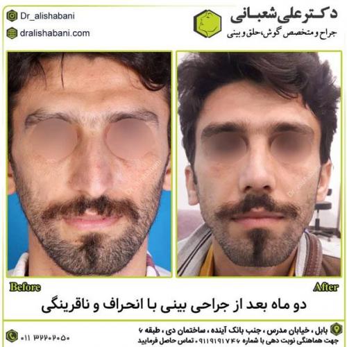 جراحی-بینی-در-بابل284