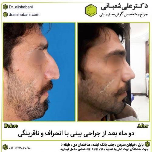 جراحی-بینی-در-بابل285