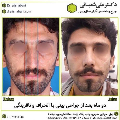 جراحی-بینی-در-بابل286