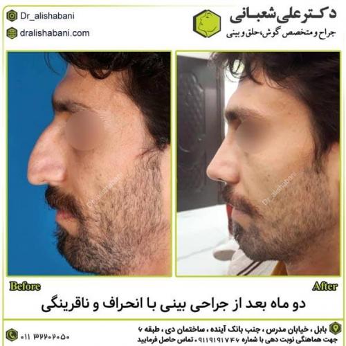 جراحی-بینی-در-بابل287