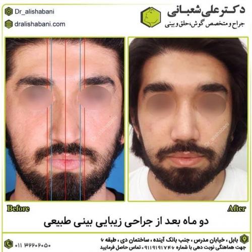 جراحی-بینی-در-بابل288