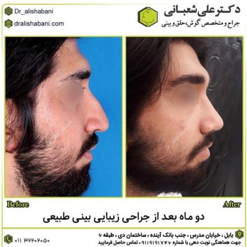 جراحی-بینی-در-بابل289