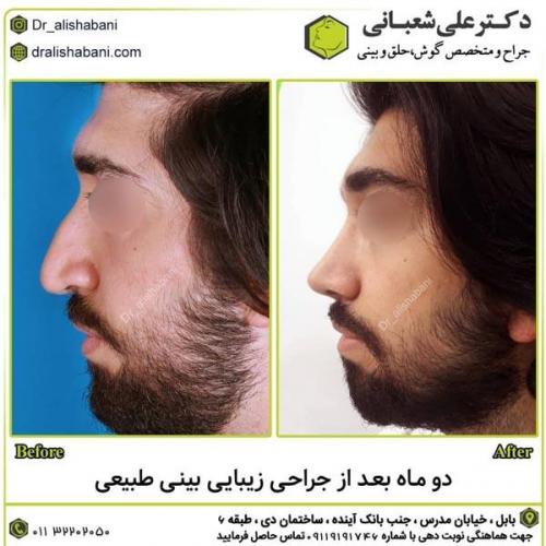 جراحی-بینی-در-بابل290