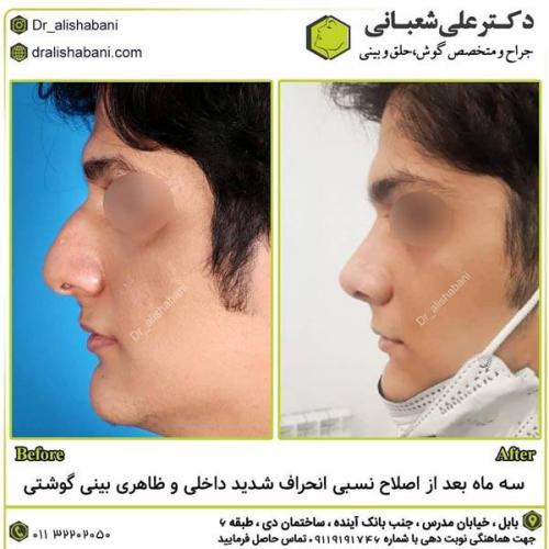 جراحی-بینی-در-بابل291