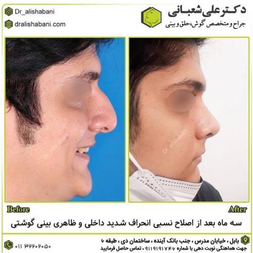 جراحی-بینی-در-بابل292