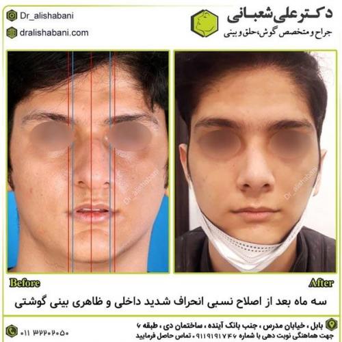جراحی-بینی-در-بابل293