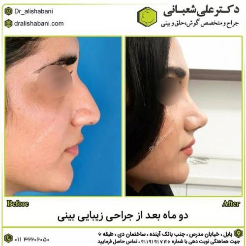 جراحی-بینی-در-بابل294