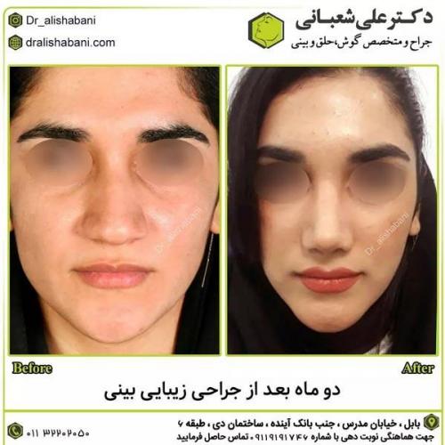 جراحی-بینی-در-بابل295