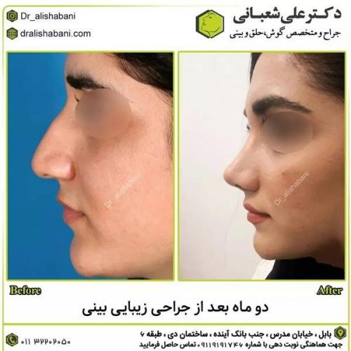 جراحی-بینی-در-بابل296