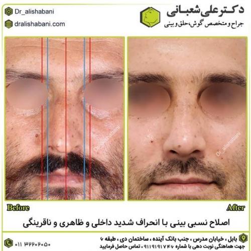 جراحی-بینی-در-بابل297