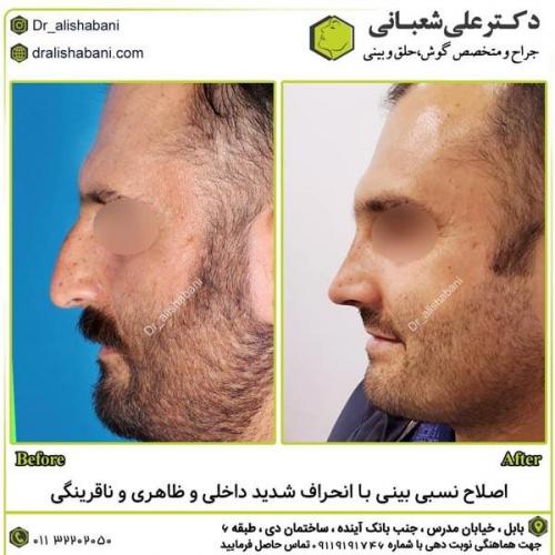 جراحی-بینی-در-بابل298