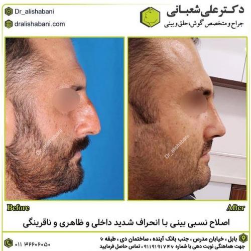 جراحی-بینی-در-بابل299