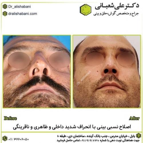 جراحی-بینی-در-بابل300