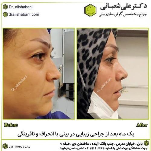 جراحی-بینی-در-بابل301