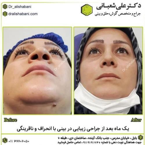 جراحی-بینی-در-بابل302