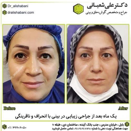 جراحی-بینی-در-بابل303