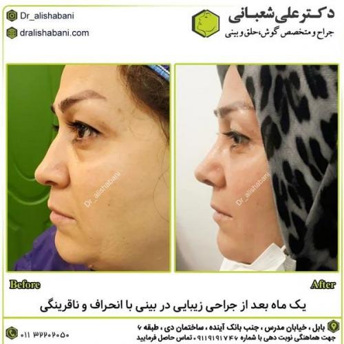جراحی-بینی-در-بابل304