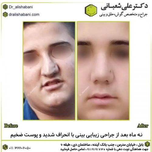 جراحی-بینی-در-بابل305